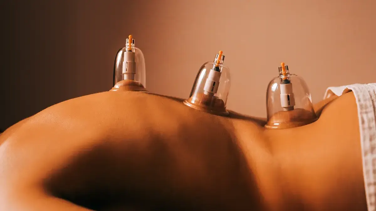 Schröpfgläser auf dem Rücken einer Patientin bei der Schröpfmassage bei RELAX plus
