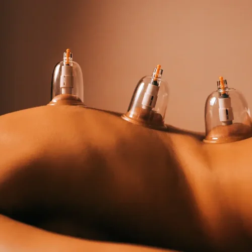 Eine Person liegt auf dem Bauch, während drei transparente Schröpfgläser entlang des Rückens angebracht sind. Die Haut ist warm beleuchtet und die Gläser erzeugen sichtbaren Unterdruck, wodurch sich die Haut leicht nach oben wölbt. Ein Handtuch bedeckt den unteren Rückenbereich teilweise.